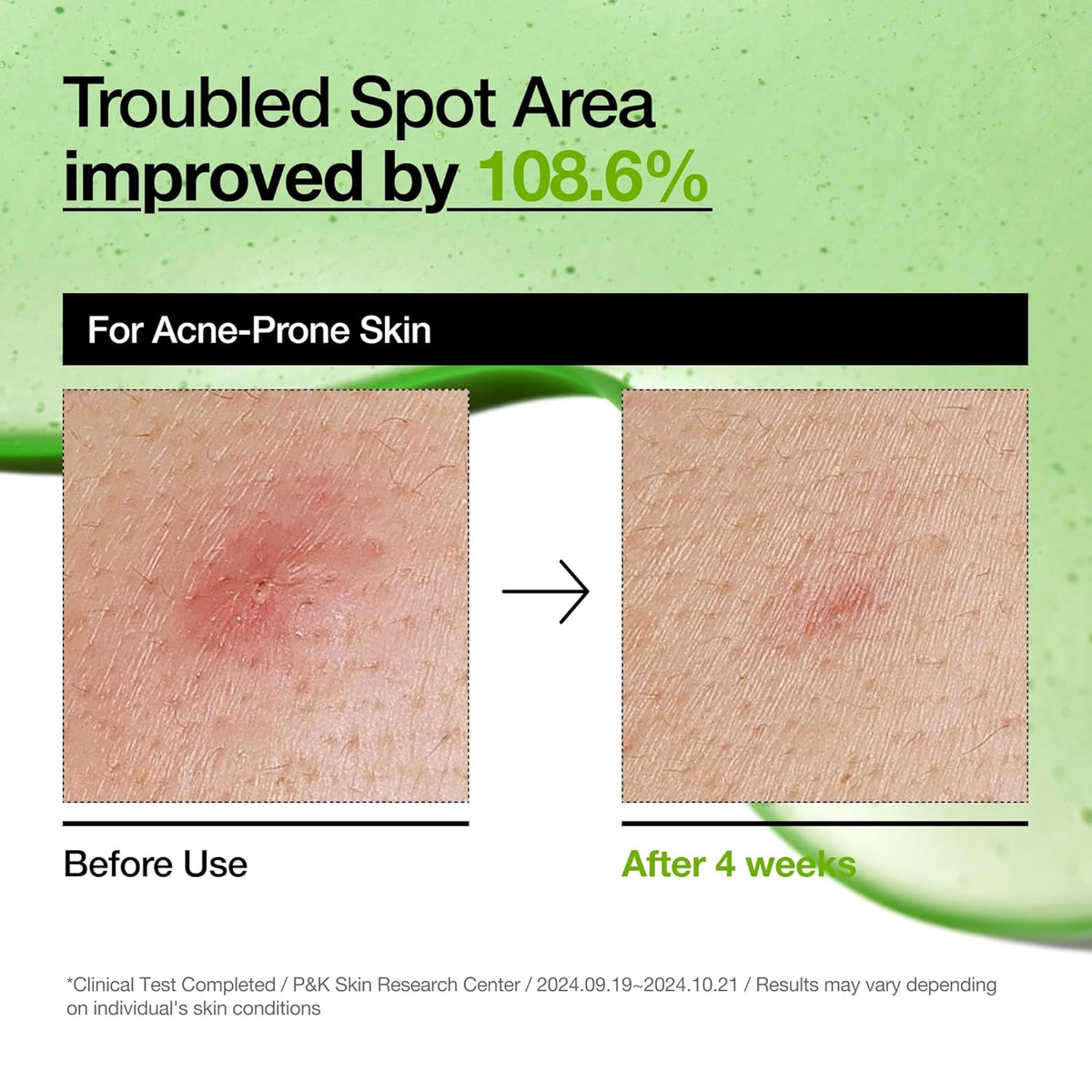Azelaic Acid 10 Hyaluron Redness Soothing Serum, Facial Serum for Sensitive Skin, Hyaluronic Acid, Niacinamide, Spot Care, Natural Color, Vegan, Korean Skincare (30Ml/ 1.01 Fl Oz.)