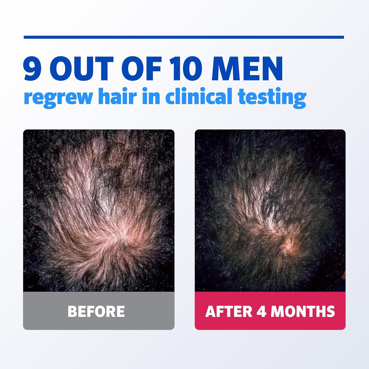 Men’S  5% Minoxidil for Men Foam, Clinically Proven Regrowth for Thinning Hair, Topical Hair Loss Treatment, Unscented Topical Aerosol, Results in 8–16 Weeks, 3-Month Supply, 3 X 2.11 Oz